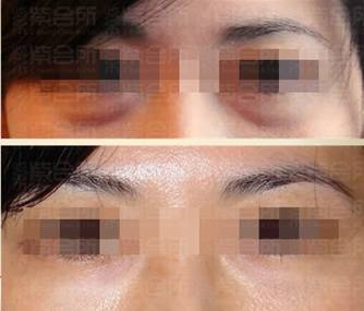 紫會(huì)所引進(jìn)韓國美塑槍除皺減肥效果好